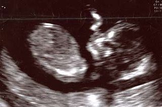 Baby 12-week scan