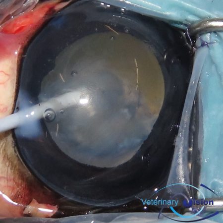 Removing-the-lens-by-phacoemulsification-e1510845123634.jpeg