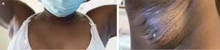 A woman in Portugal started to lactate from her armpit after giving birth. Above, images showing the mass in the woman's right armpit (left), and the white discharge that leaked from the mass (right.)