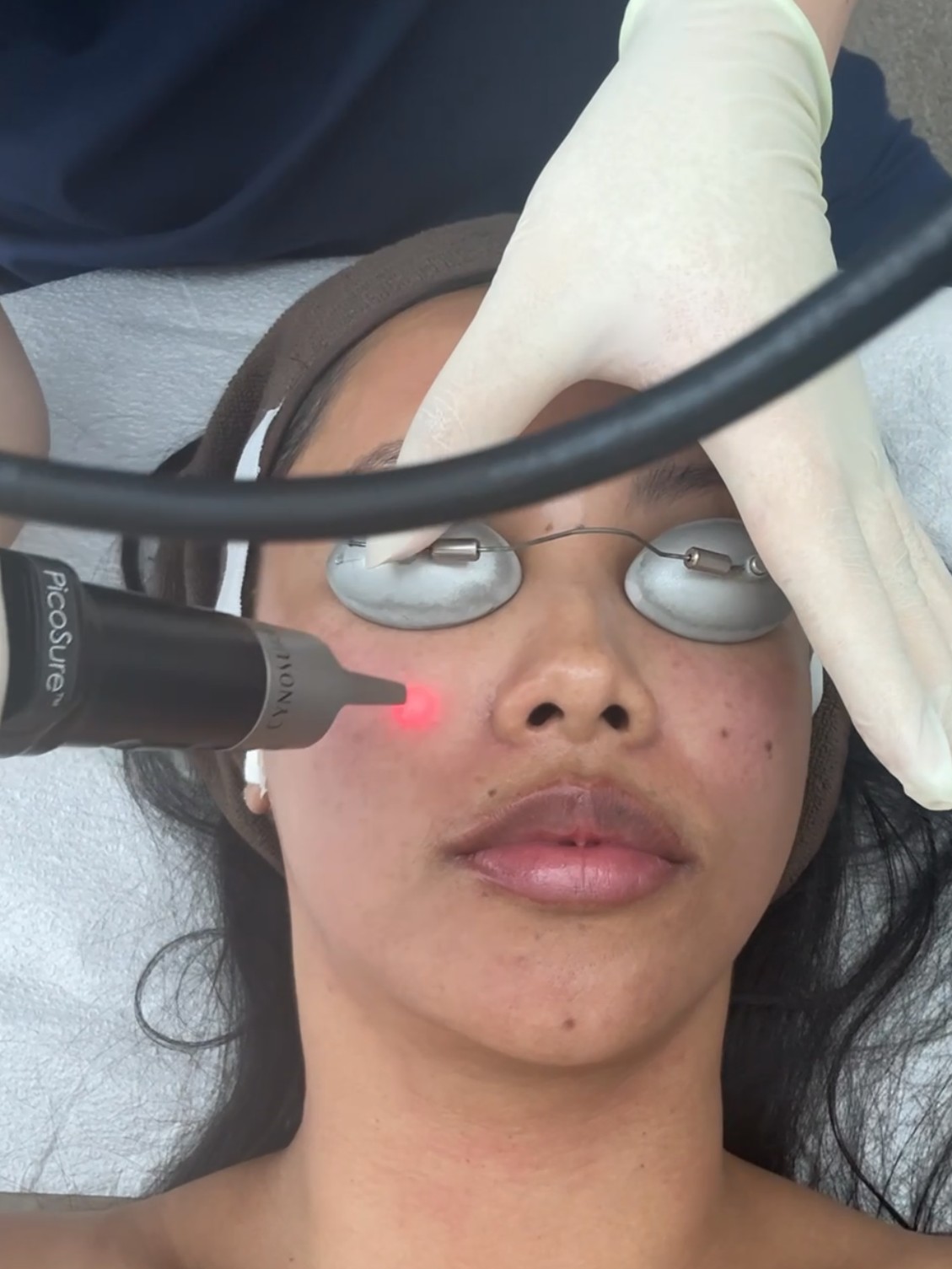 Vanessa Lee PicoSure Pro Laser Review