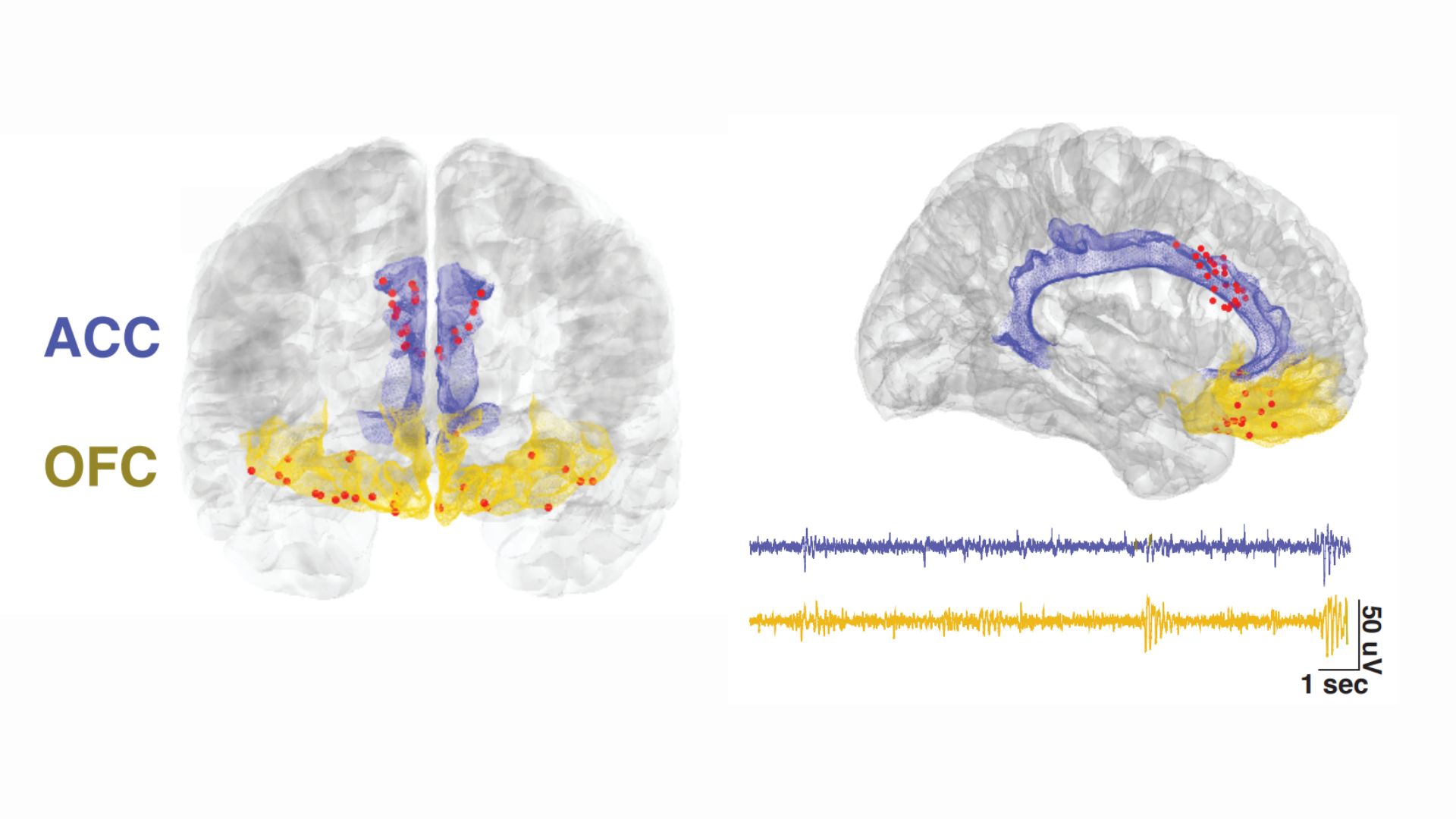 two cross sections of the human brain show red dots where participants in the new study had electrodes implanted in their heads. Two brain regions, one called the ACC and one called the OFC, are highlighted in purple and yellow, respectively. There's also wave forms at the in the diagram, showing the activity of both these regions