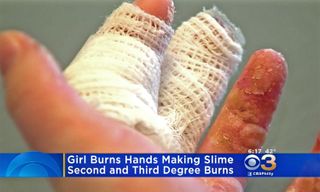 borax, slime burn, burn