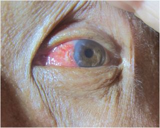 An image of the surfer's eye 3 days after injury shows the pterygium on the cornea is cleared and there is mild local inflammation.