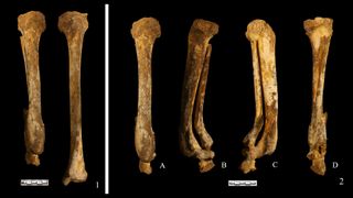 This image shows 2 leg bones at different angles, the lower right leg being amputated. The rough endings on the bones of the lower right leg suggest the amputation was inflicted as a punishment and was not the result of an accident or disease.