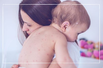 Woman holding baby covered in chickenpox