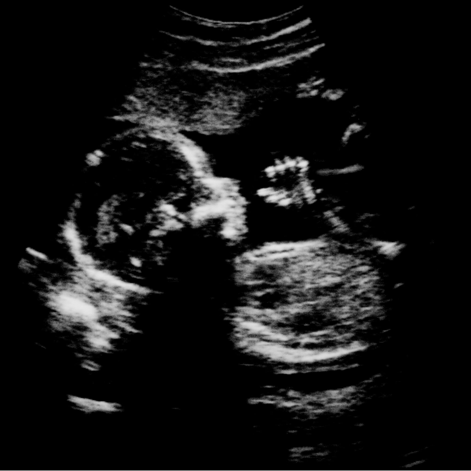 How to Preserve Your Adorable Ultrasound Pictures  Ultrasound pictures,  Ultrasound, Sonogram pictures