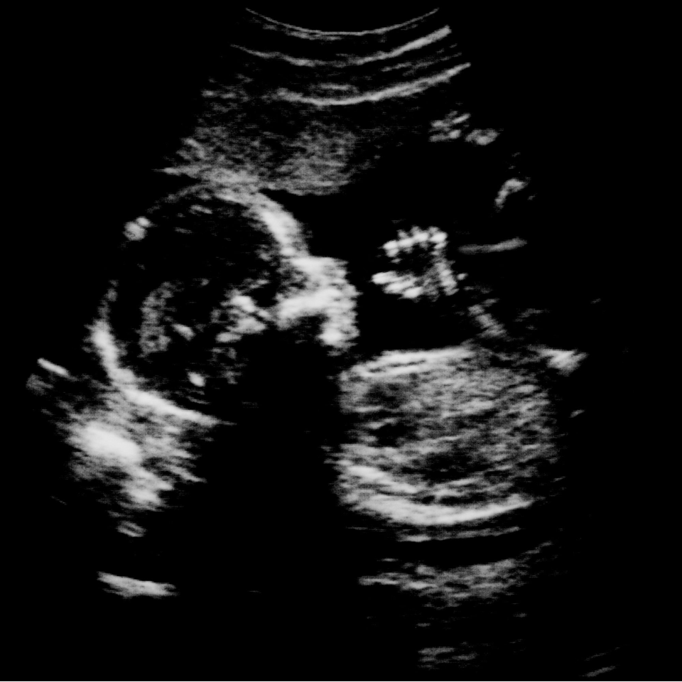 Are Ultrasound Photos Affecting Abortion Rates?