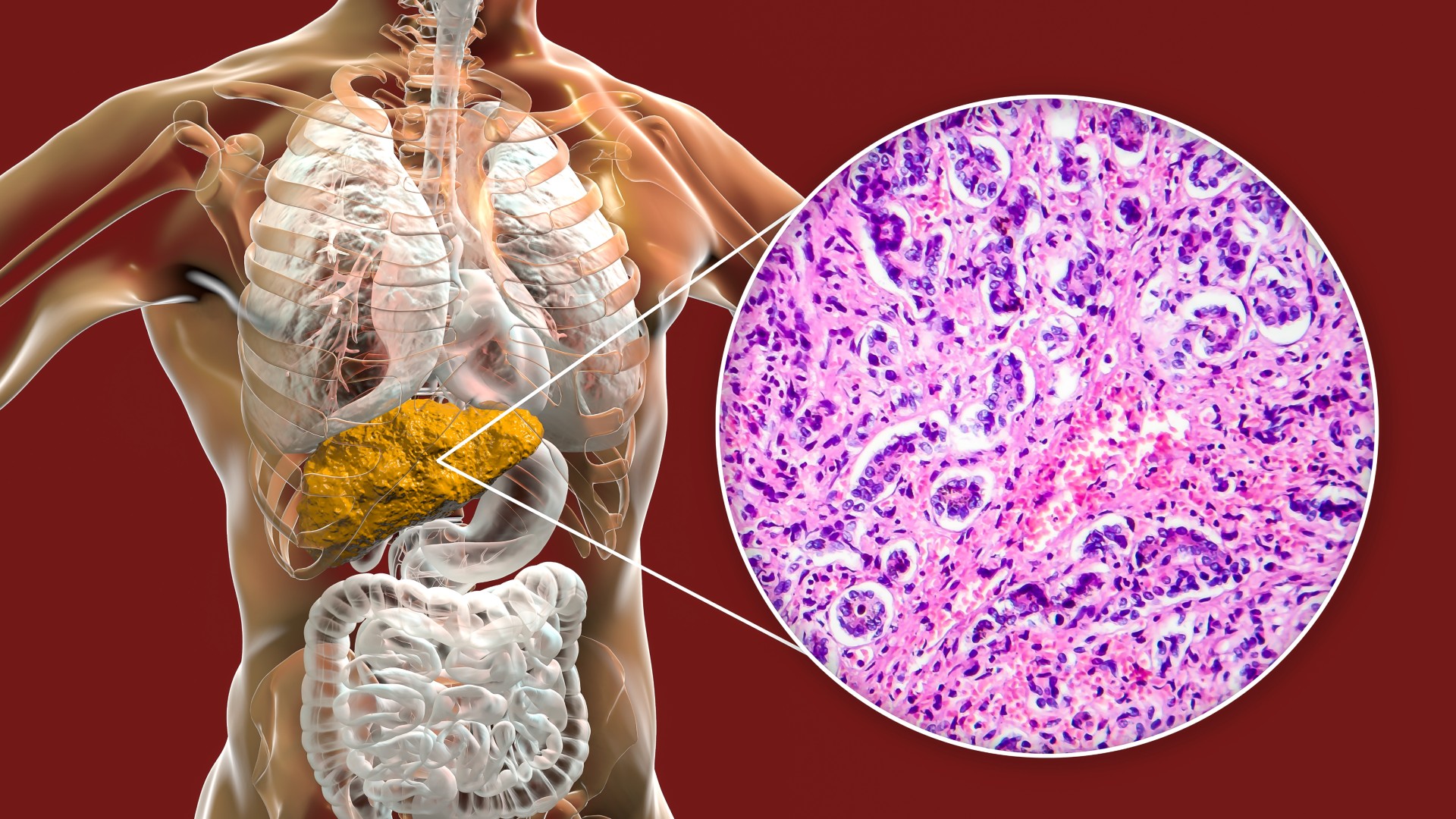 O ilustrare a secțiunii mijlocii a corpului unei persoane. O bulă pop-out iese din ficat și în interior conține o imagine a celulelor sub microscop.