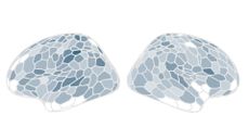 Two stylized images showing the amount of gray matter in the brain.