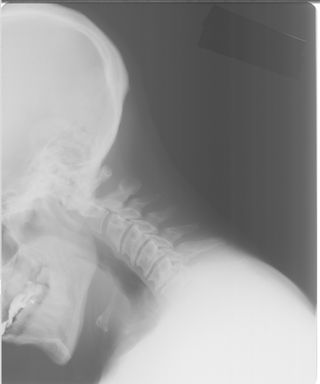 Neck x-ray image.