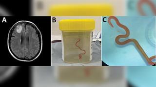 Figure from paper showing an MRI scan of a lesion in the woman's brain on the left and two images of the extracted worm on the right