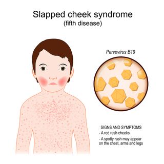 An illustration showing the common symptoms of slapped cheek syndrome and a picture of what the rash looks like