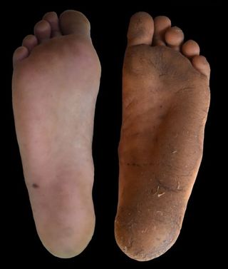 A new study examined how the effects of foot calluses compared with those of shoes. Above, the foot of a person who typically wears shoes (left) versus the foot of a barefoot walker.