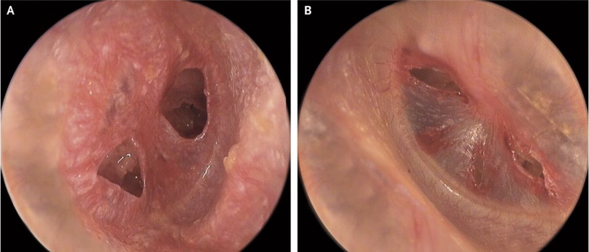 ruptured eardrum, eardrum