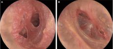 ruptured eardrum, eardrum