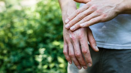 how-to-treat-psoriasis