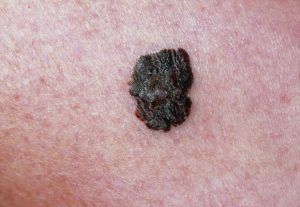 cancerous moles: malignant melanoma
