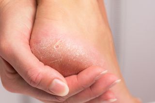 woman's hand holding her heel which had dry hard skin