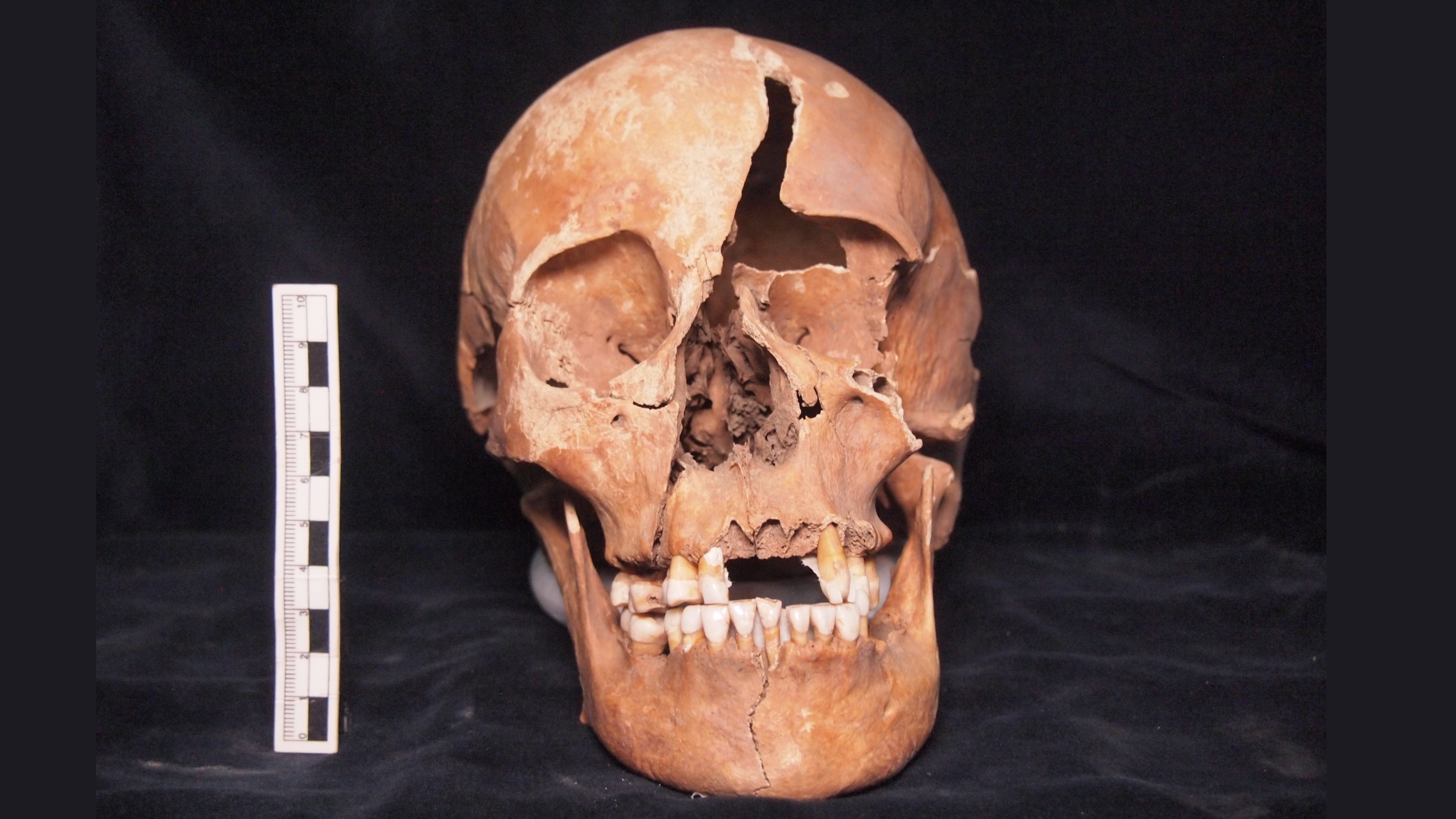 A human skull sits against a black background with a measurement scale vertically next to it. The skull has a massive perimortem slash to the face.