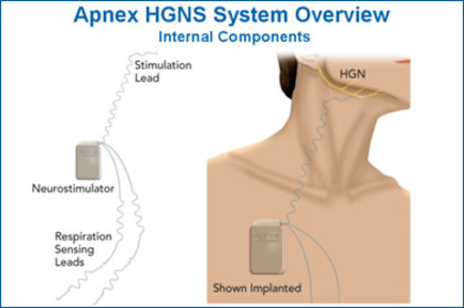 The apnex