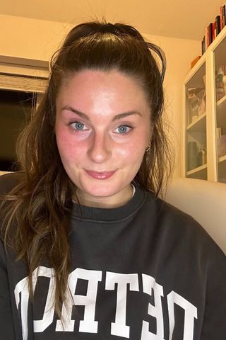 Tori with Rosalique 3-in-1 Anti-Redness Miracle Formula on the right side of her face, but bare skin on the left showing the reduction of redness
