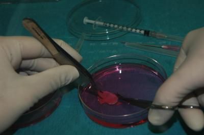 This photograph shows a piece of ovarian tissue in a petri dish before it was frozen and stored for transplantation at a later date.