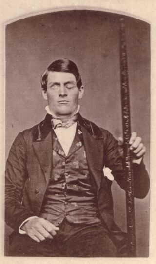 Phineas Gage poses with his "constant companion," the tamping iron that was removed from his brain.