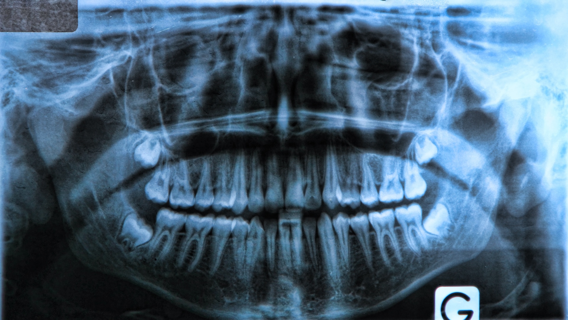 A panoramic X-ray showing a set of human teeth with several impacted wisdom teeth