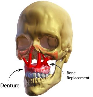 Final optimized result with denture inserted into the craniofacial skeleton.