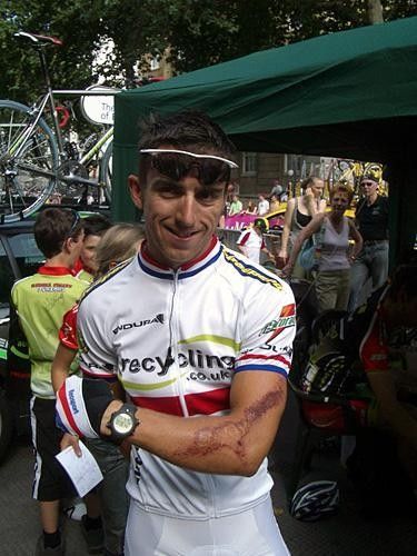 Russell Downing (recycling.co.uk) shows off the scars from his crash during the 2005 Tour of Britain.