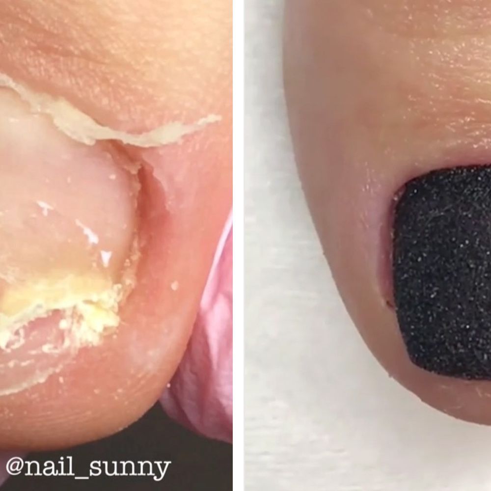 We Can't Stop Watching This Toenail Reconstruction - How to Fix Broken  Tonenail | Marie Claire