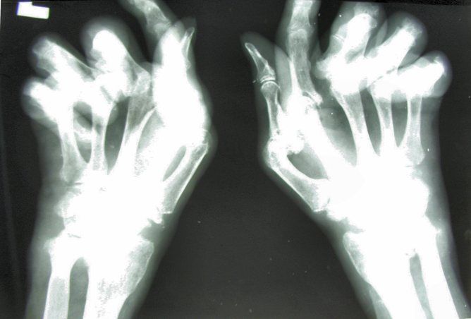 Hand x-ray, rheumatoid arthritis