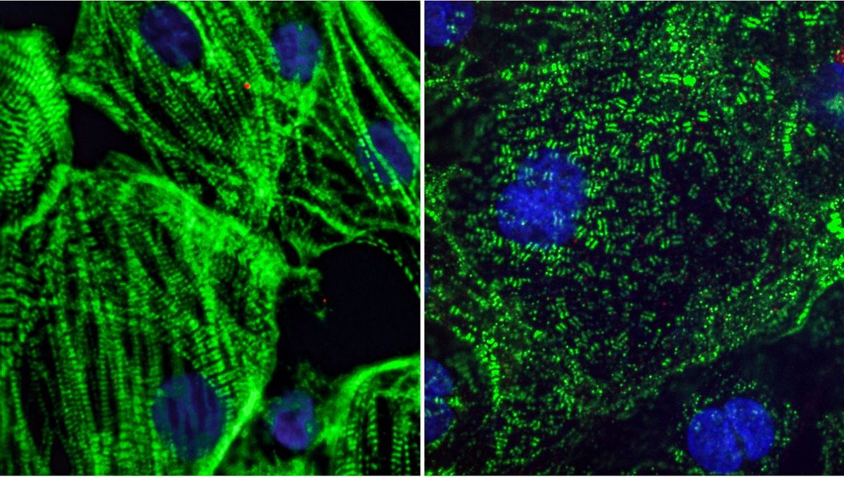 When scientists mixed the new coronavirus with heart cells in a lab dish, the virus appeared to carve heart muscle fibers into small fragments. On the left, an image of healthy heart muscle cells, which have long fibers that allow them to contract. On the right, an image of heart muscle cells infected with SARS-CoV-2 in which the long fibers appeared to be diced into small pieces.