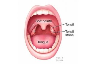 Tonsil Stones Causes Removal Prevention Live Science