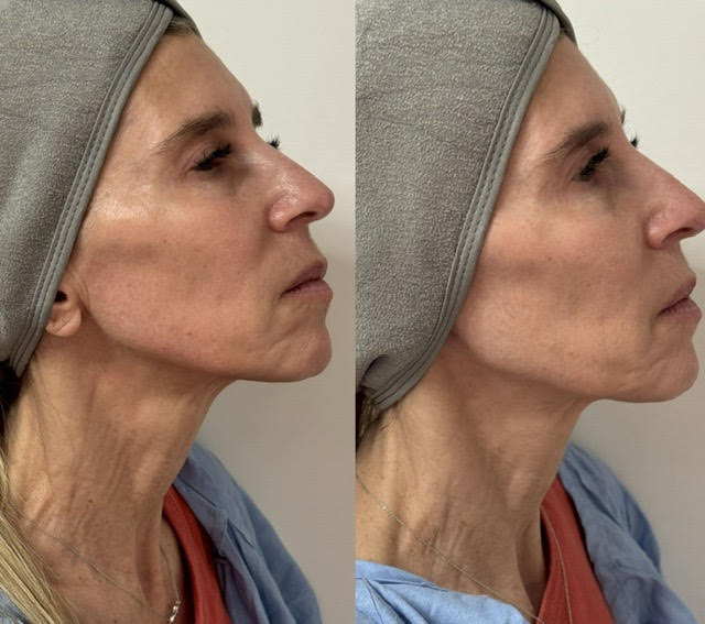 a before and after photo of a woman&#039;s neck