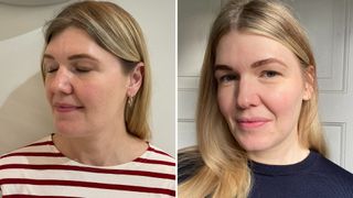 Fiona McKim before and after having skin boosters