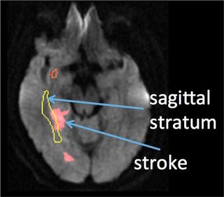 People with damage to the sagittal stratum (yellow outline) after a right hemisphere stroke tend to have trouble understanding sarcasm.