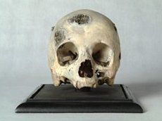 Example of tumours of the skull from William Hunter's pathological collection (courtesy of University of Glasgow)
