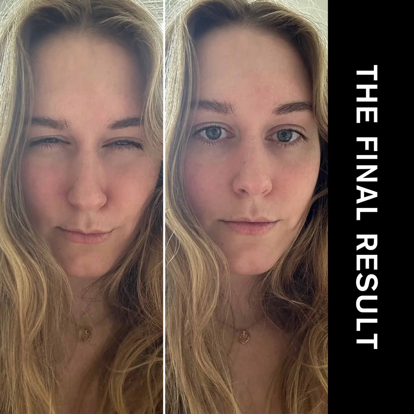 Beauty editor Kaitlyn McLintock after Dysport injections