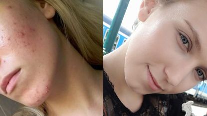 This Woman's Before-and-After Accutane Photo on Reddit Is Insane | Marie  Claire
