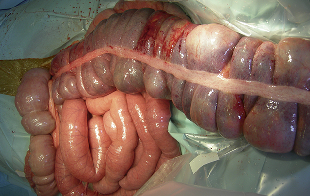 1-Colon-torsion-surgery.jpg