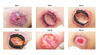Images of lesions from a brown recluse spider bite over the course of 56 days. (Bitten by Brown Recluse Spider_The New England Journal of Medicine ©2013)