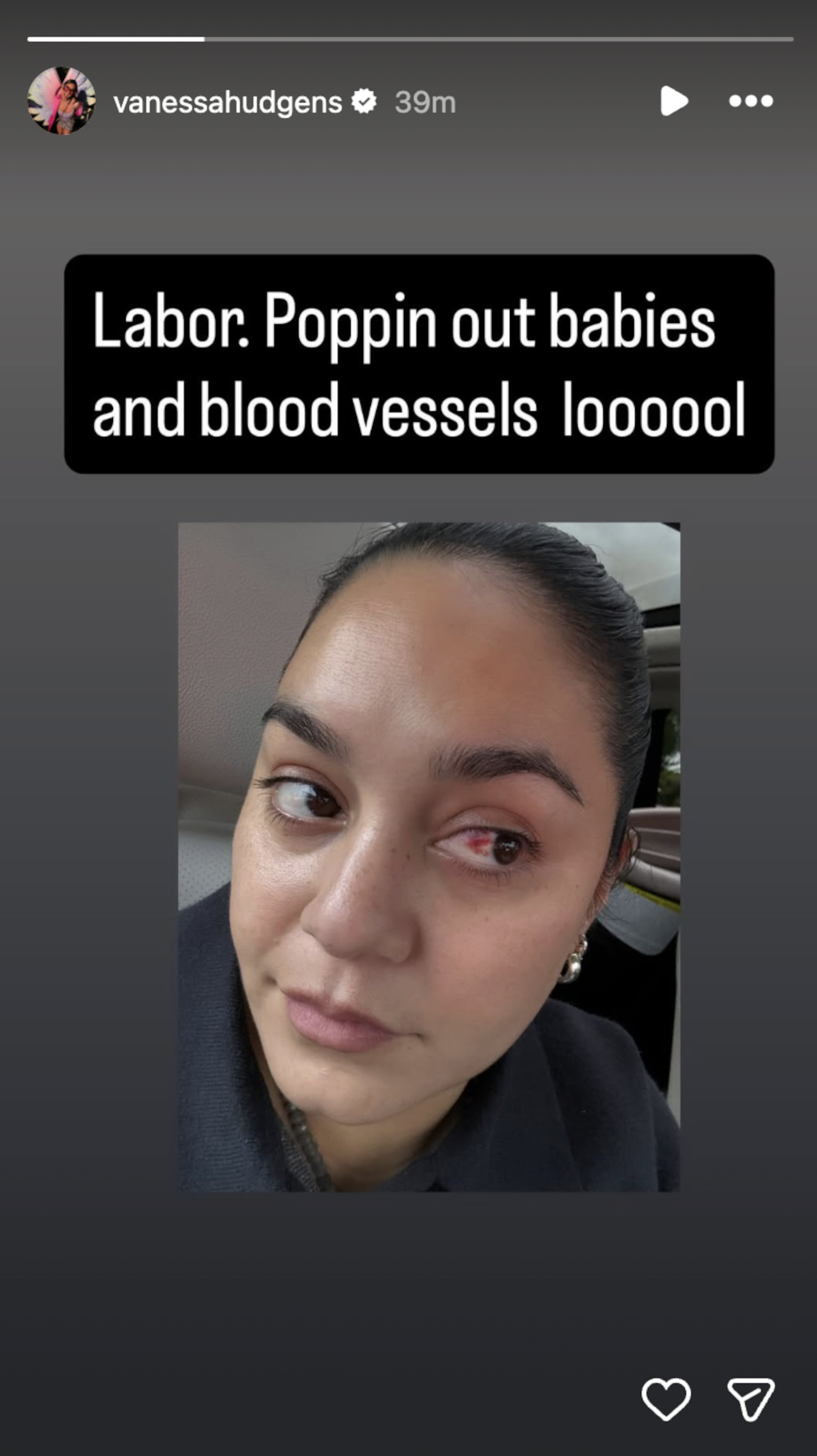 Vanessa Hudgens posted a selfie showing off her red eye with the caption &quot;Labor. Poppin out babies and blood vessels loooool.&quot;