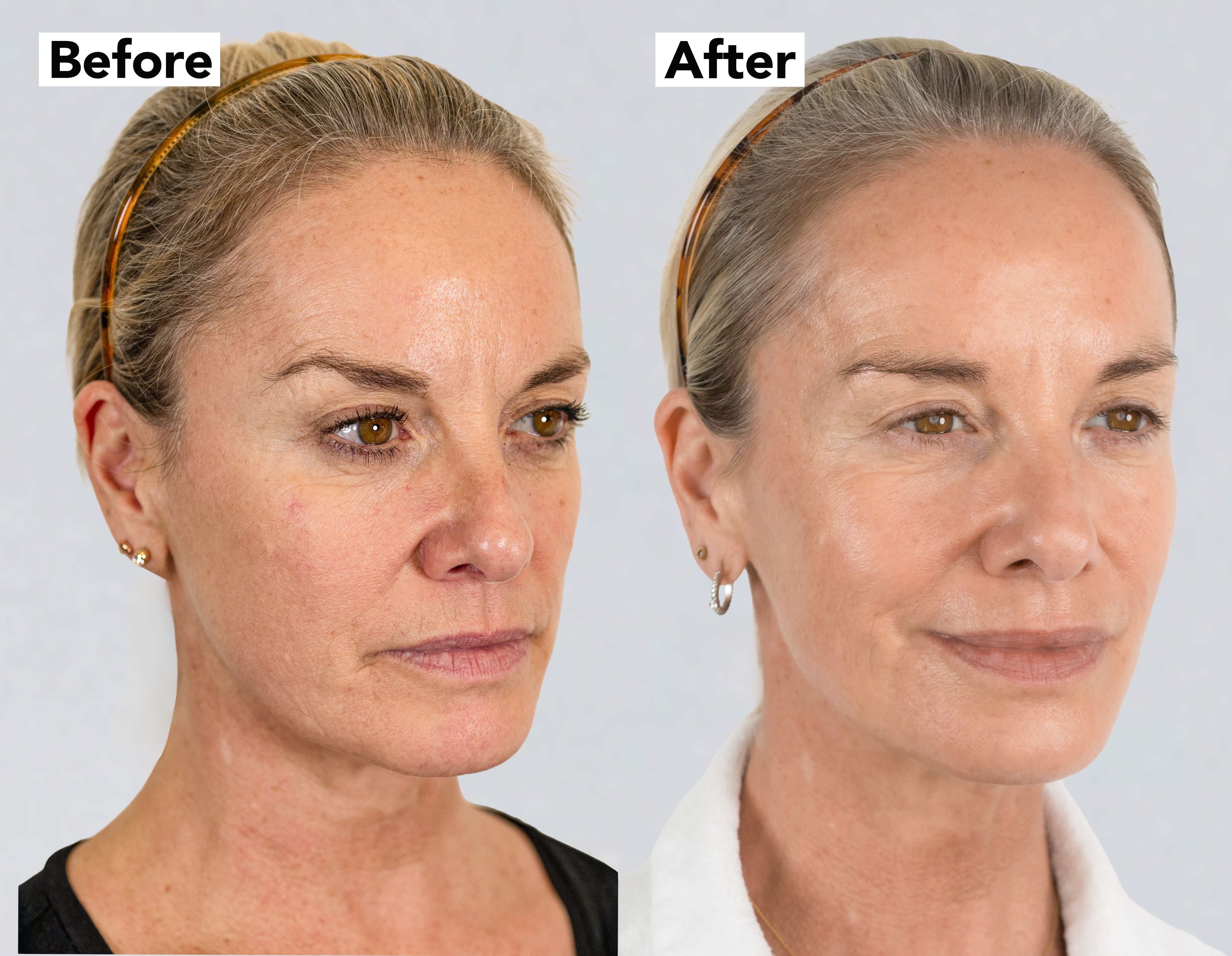 Tamzin Outhwaite before &amp;amp; after NeoGen Plasma