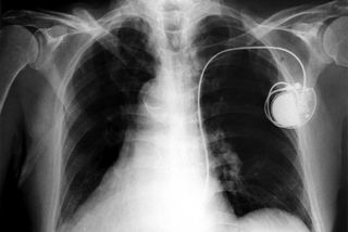 An x-ray reveals a pacemaker inside a chest. 