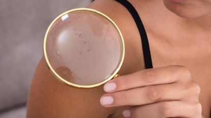 Skin cancer? Close-up Of Young Woman Showing Skin On Shoulder Using Magnifying Glass At Home