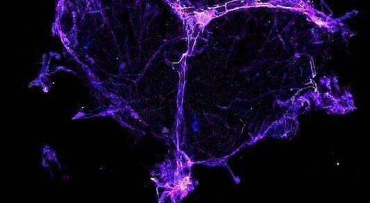 'Chemo brain' may stem from damage to the brain's drainage system