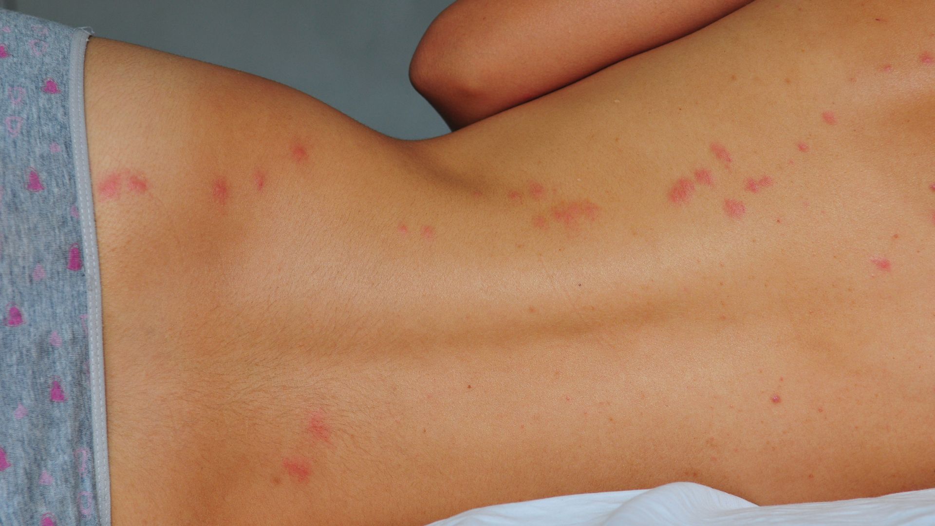 A woman lays on her side, exposing a track of bed bug bites accross her back