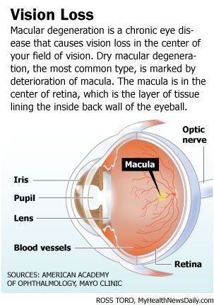 Macular Degeneration is a chronic eye disorder causing vision loss in the retina, located in the center of the eye.