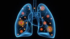 3D image of coronavirus particles attacking the lungs.